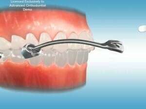 Le Motion, correcteur de Classe II par rotation de la 1ère molaire