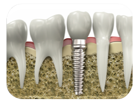LES IMPLANTS DENTAIRES