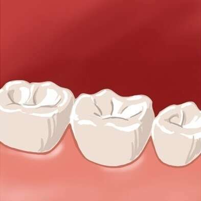 LE BRIDGE CANTILEVER ET LE BRIDGE COLLE