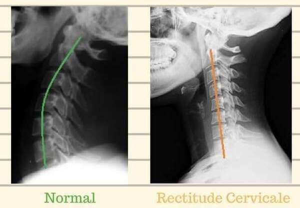 Et si votre cou était... trop droit ? 