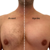 épilation laser torse homme avant / après