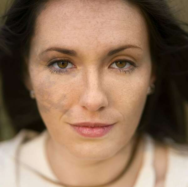 Comment traiter efficacement les taches brunes sur la peau ?