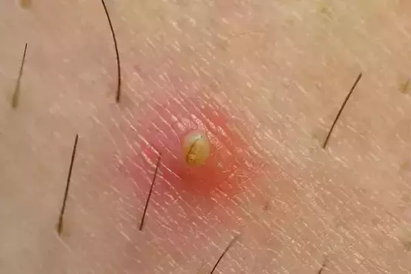 Comment éviter les poils incarnés ?