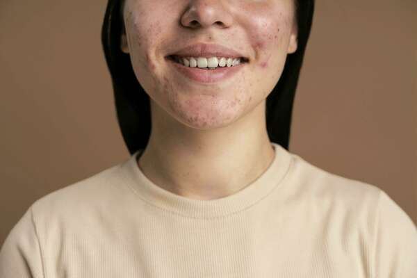 Comment prévenir et traiter efficacement la couperose ? 