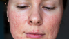 visage d'une jeune femme, couperose