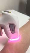 épilation laser