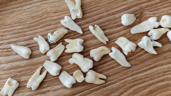 Les extractions dentaires : Quand et pourquoi les réaliser ?