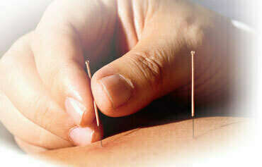 acupuncture2
