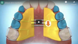 plaque vérin maxillaire