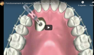 Fonctionnement de l'appareil dentaire chez les adulte