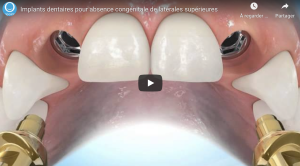 Implants dentaires pour absence congénitale de latérales supérieures
