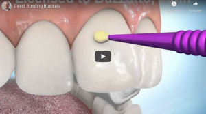 Direct Bonding Brackets