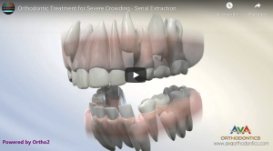 Orthodontic Treatment for Severe Crowding - Serial Extraction