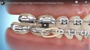 Correction avec élastique classe 2.