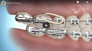 Correction avec élastique classe 3.