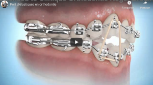 Élastique inter-maxillaire