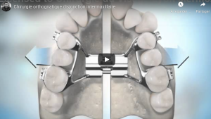 Disjonction intermaxillaire