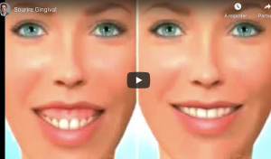 Traitement du sourire gingival