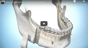 Chirurgie bimaxillaire du sens transversal