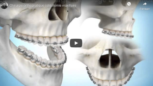 Chirurgie maxillaire de classe III
