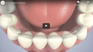 La Contention dentaire