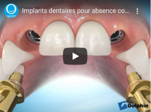 Implants dentaires et agénésies