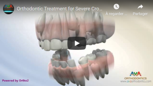 Extractions pilotées