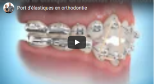 Élastique inter-maxillaire