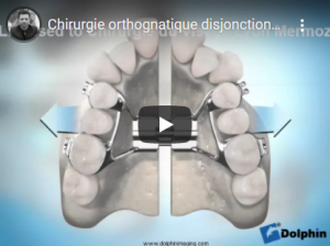 Disjonction intermaxillaire