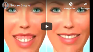 Traitement du sourire gingival