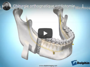 Chirurgie bimaxillaire du sens transversal
