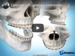 Chirurgie maxillaire de classe III