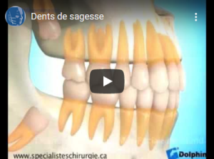 Dents de sagesse