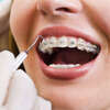 Orthodontie bagues