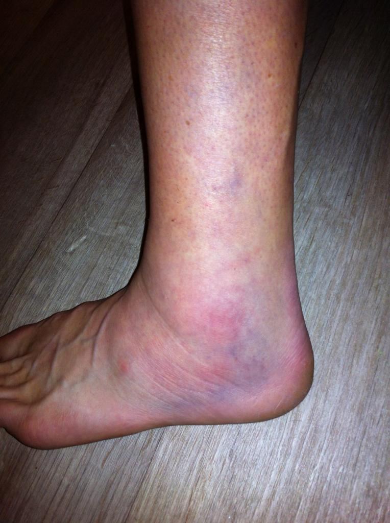 Que faire en cas d'entorse de cheville ? Blog