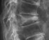 fracture tassement osteoporose osteo nandy