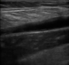echographie tennis leg