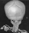 deformation crane aplatissement plagiocephalie