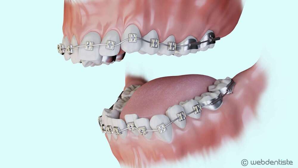 Traitement multi-attaches