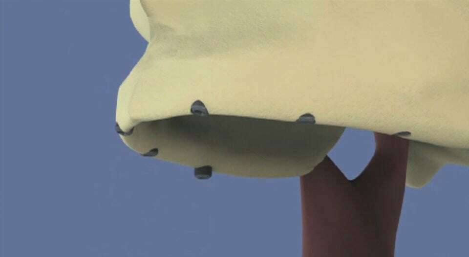 Maxillaire all-on-6 et comblement de sinus