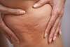 cellulite dure et fibrosée avec capitons visibles
