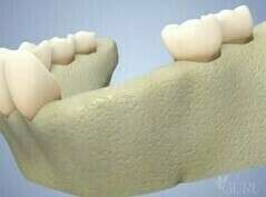 LA REGENERATION OSSEUSE GUIDEE