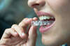 Gouttières invisibles pour aligner les dents