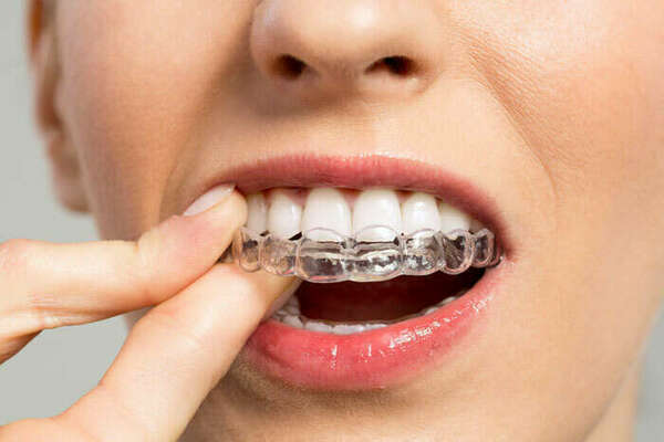 LA TECHNIQUE INVISALIGN® – ALIGN TECHNOLOGY