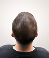 micropigmentation capillaire traitement progressif à Paris