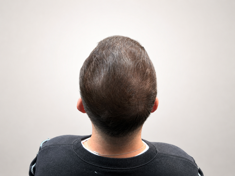 Avant après tricopigmentation