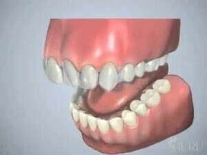 TRAITEMENT ESTHETIQUE PAR GOUTTIERE