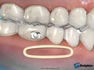 INVISALIGN TIM CLASS II