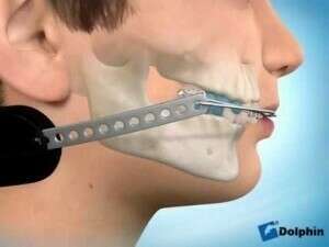 Appareil de nuit - Traction basse