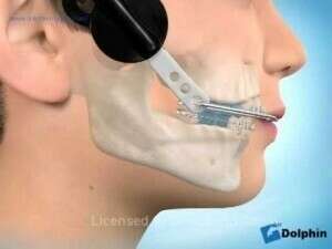 Appareil de nuit - Traction haute